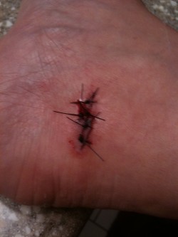 Five stitches